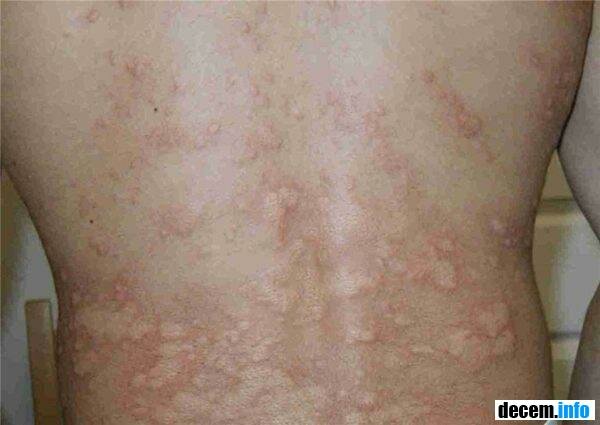 Aquagenic urticaria