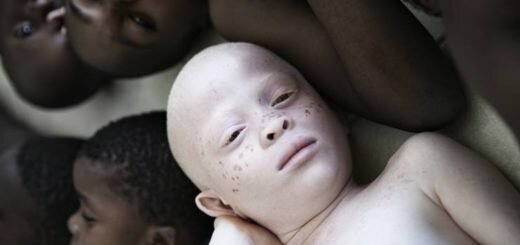 противоядия от альбинизма